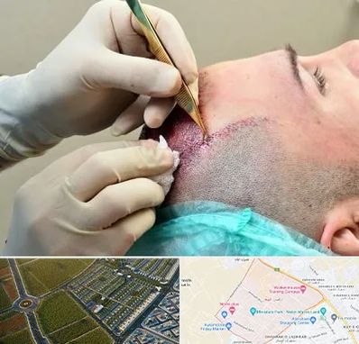 کلینیک کاشت مو در الهیه مشهد