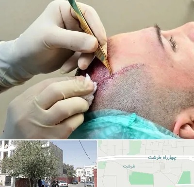 کلینیک کاشت مو در طرشت