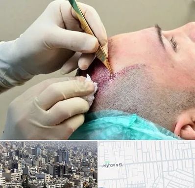 کلینیک کاشت مو در جیحون