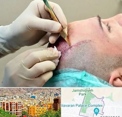 کلینیک کاشت مو در نیاوران