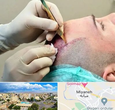 کلینیک کاشت مو در میانه