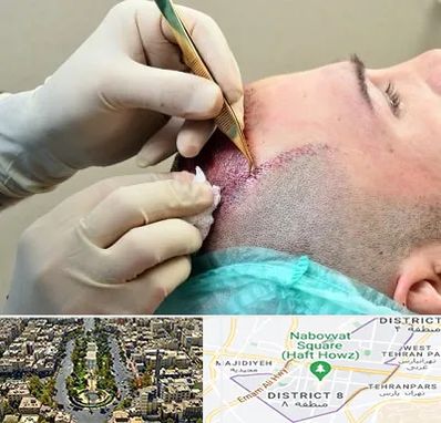 کلینیک کاشت مو در نارمک