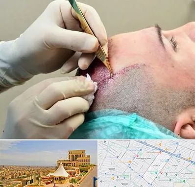 کلینیک کاشت مو در هاشمیه مشهد