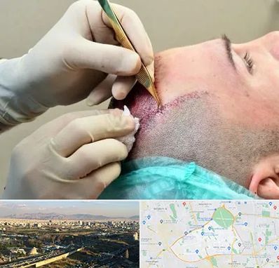 کلینیک کاشت مو در منطقه 19 تهران