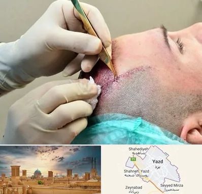 کلینیک کاشت مو در یزد