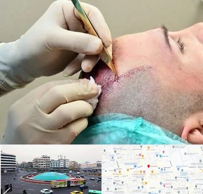 کلینیک کاشت مو در میدان انقلاب