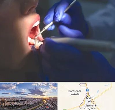 عصب کشی در قم