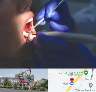 عصب کشی در هروی