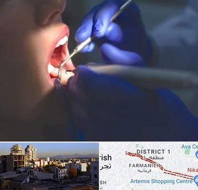 عصب کشی در فرمانیه