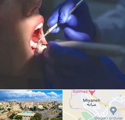 عصب کشی در میانه