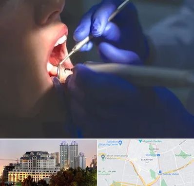 عصب کشی در فرشته 