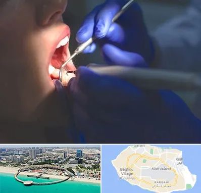 عصب کشی در کیش