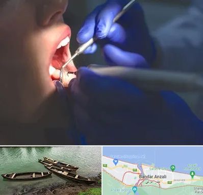 عصب کشی در بندر انزلی