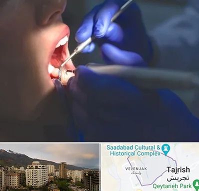 عصب کشی در زعفرانیه