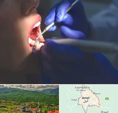 عصب کشی در آمل