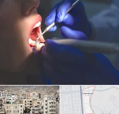 عصب کشی در اسکندری