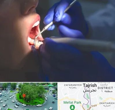 عصب کشی در تجریش 