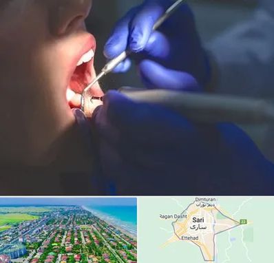 عصب کشی در ساری