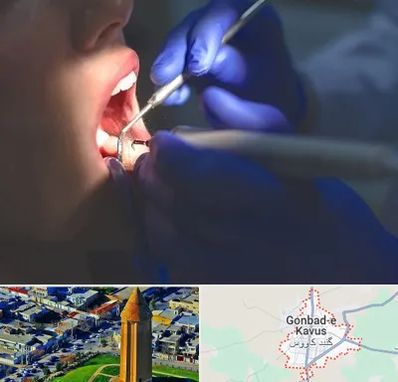 عصب کشی در گنبد کاووس
