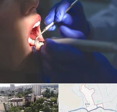 عصب کشی در اوین