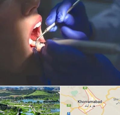 عصب کشی در خرم آباد