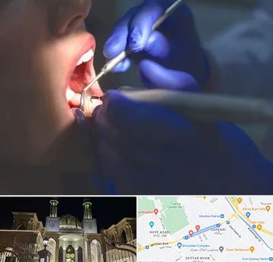 عصب کشی در زرگری شیراز