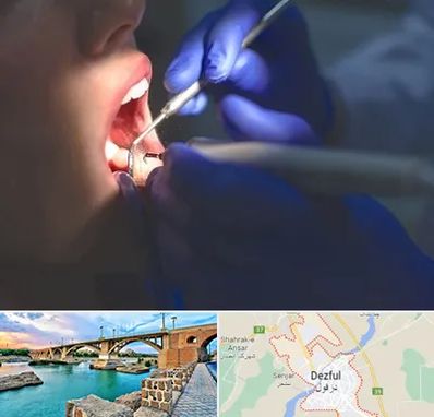 عصب کشی در دزفول