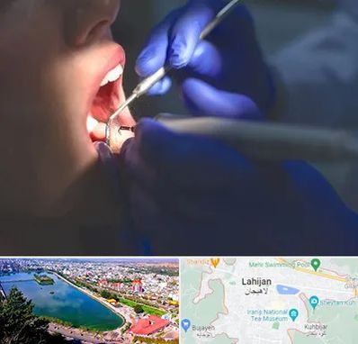 عصب کشی در لاهیجان