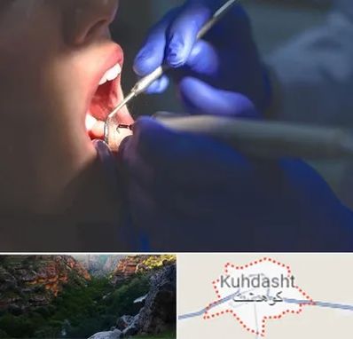 عصب کشی در کوهدشت