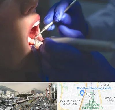 عصب کشی در پونک 