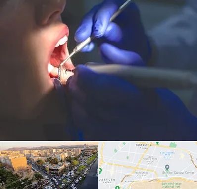 عصب کشی در تهرانپارس 