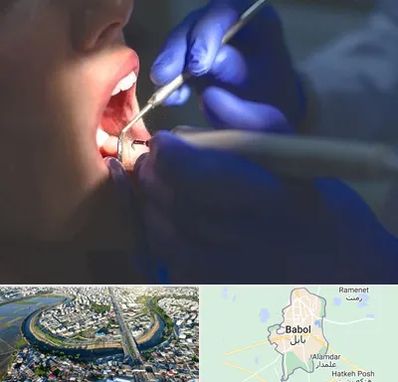 عصب کشی در بابل