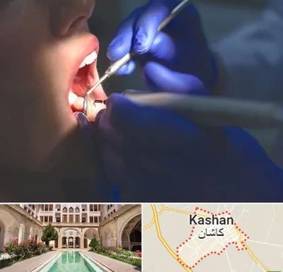 عصب کشی در کاشان