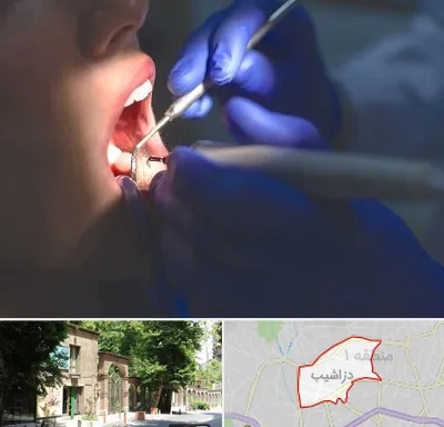 عصب کشی در دزاشیب