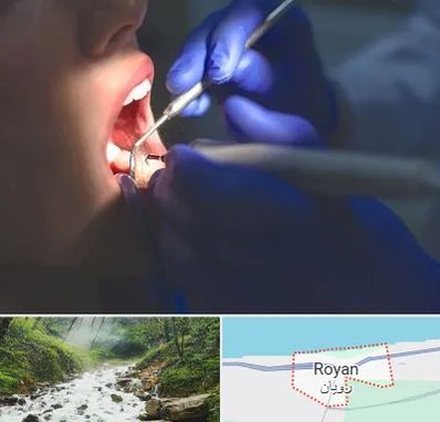 عصب کشی در رویان