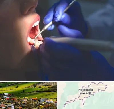 عصب کشی در کلاردشت