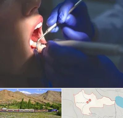 عصب کشی در خاش