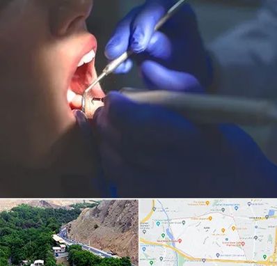 عصب کشی در کن