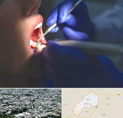 عصب کشی در شاهرود