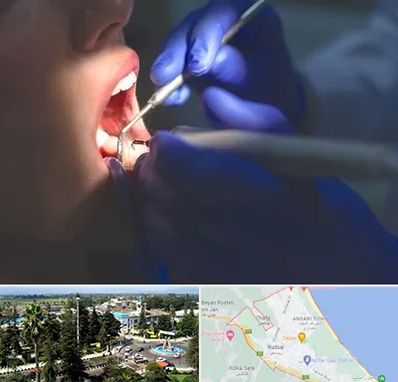 عصب کشی در رودسر