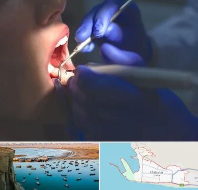 عصب کشی در چابهار