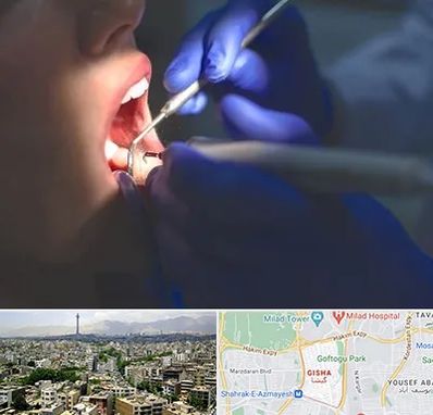 عصب کشی در گیشا