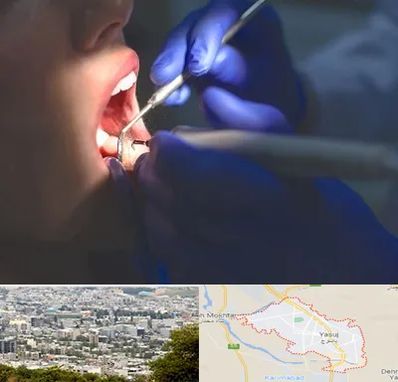 عصب کشی در یاسوج