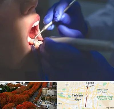 عصب کشی در ولیعصر