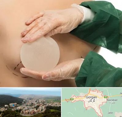 جراحی پروتز سینه در گرگان