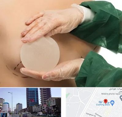 جراحی پروتز سینه در چهارراه طالقانی کرج