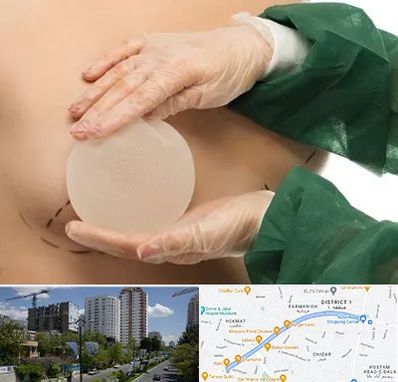 جراحی پروتز سینه در اندرزگو