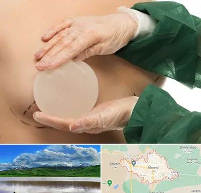 جراحی پروتز سینه در مرند