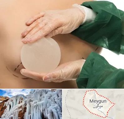 جراحی پروتز سینه در میگون