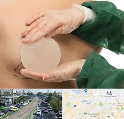 جراحی پروتز سینه در جنوب تهران